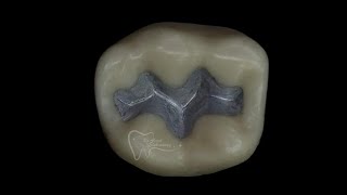 class 1 amalgam restoration for lower 6 [upl. by Mahla]