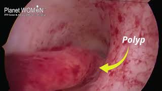 Hysteroscopic Polypectomy I Dr Mehul Damani I Planet WOMEN [upl. by Terza]