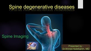 1spine degenerative diseases [upl. by Meihar555]