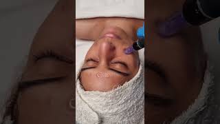 nanoneedling treatment for Open pores 🤩 youtubeshorts shotsskincare microneedling nanoneedling [upl. by Lati805]