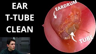 Tympanostomy Tube Cleaned Eardrum Tube [upl. by Yawnoc]