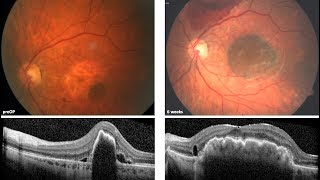 Aderhautpatch zur Behandlung der feuchten AMD mit Pigmentepitheleinriss RIP – Prof Peter Szurman [upl. by Morna]