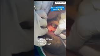 Operculectomy procedure [upl. by Narat]