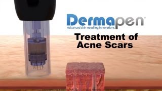 MicroNeedling for Acne Scars  Dermapen® Treatment [upl. by Ahsienek]