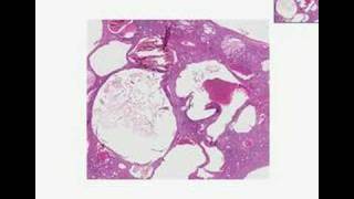 Histopathology KidneyAdult polycystic disease [upl. by Revlis497]