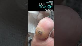 Toe CallusInflammationΚάλος κεντροποδιου kentropodiou podiatry podologia podiatrist callus [upl. by Earised]