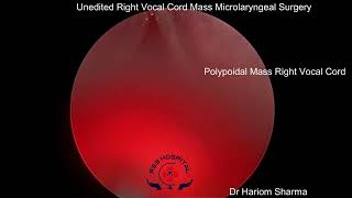 Microlaryngeal Surgery  Voice Surgery  MLS Surgery  Vocal Cord Polyp Surgery [upl. by Schreibman]