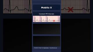 Type II Second Degree Atrioventricular Block ECG Constant PR intervals [upl. by Nirot]