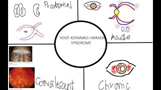 VOGT KOYANAGI HARADA SYNDROME KanskiSeries 2022 [upl. by Sallee]