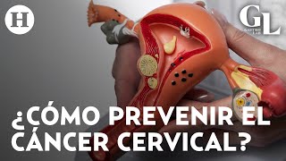 Cáncer de cuello uterino  Recomendaciones para evitar la segunda causa de muerte en México [upl. by Rehpotsirc]