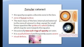 Ophthalmology 190 b Zonular Lamellar Cataract Congenital Nuclear Lens Eye [upl. by Sivram43]