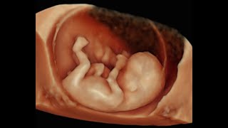 How to Perform 3D Scan of the Baby at 12 Weeks of Pregnancy [upl. by Hieronymus]