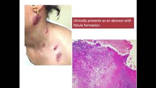 Cutaneous Tuberculosis  Clinical presentation and Histopathology [upl. by Reynolds286]