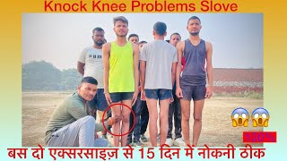 Knock Knee Problem Solution Knock Knee जड़ से ठीक करें  नोक नी Best Exercise Ravi Fauji [upl. by Davita269]