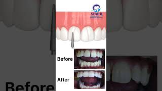 Before amp After Filling Gaps Between Teeth  Shahi Dental Clinic Muzaffarpur [upl. by Trevar]