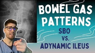 SBO vs Adynamic Ileus Learn the 369 rule to read bowel gas patterns on Xrays [upl. by Baelbeer106]