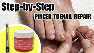 Fix Trumpet Toenail at Home  How to Use Pincer Toenail Kit nails satisfying [upl. by Neisa]