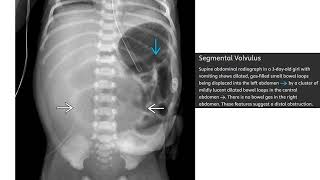 Segmental Volvulus Imaging [upl. by Emmalyn]