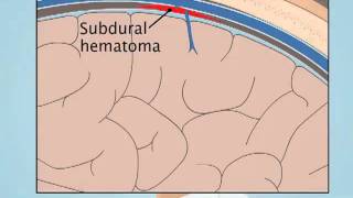 Understanding Subdural Hematoma [upl. by Lowery]