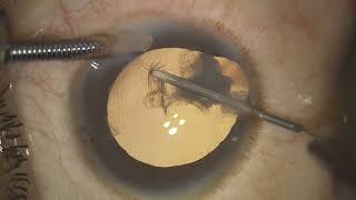 Phaco in an eye with IRIS COLOBOMA [upl. by Clippard]