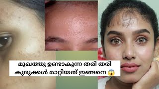 14 days challenge  How to Remove Tiny bumps at home  tiny bumps malayalam  glamyganga [upl. by Annirok]