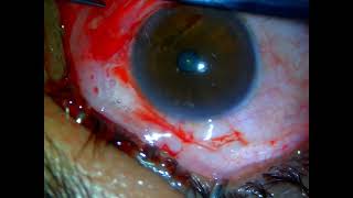 Pterygium Surgery with conjunctival autograft without glue [upl. by Nollat]