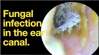 Fungal infection in the ear canal ear wax removal  ear cleaning  ASMR  relaxation  relax [upl. by Nellak163]