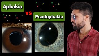 Aphakia  Psudophakia lecture opthalmology [upl. by Cynth133]