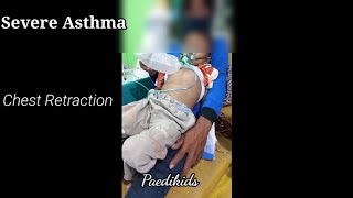 Chest Retraction Severe Asthma [upl. by Malo]