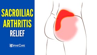 How to Instantly Relieve Arthritic Sacroiliac Joint Pain [upl. by Esmaria]