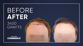 COSMEDICA DRACAR 3400 Grafts FUE Hair Transplant in TurkeyIstanbul [upl. by Lunsford]