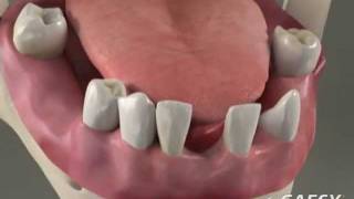 Dentures Overdentures  Roseville Dentist [upl. by Edgell223]