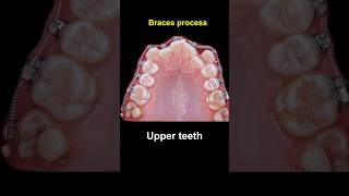 Braces duration  28 months braces orthodontist bracesoff dentist [upl. by Geiger]