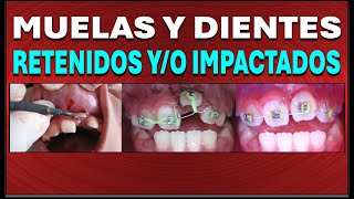 DIENTES O MOLARES RETENIDOS INCLUIDOS O IMPACTADOS  CAUSA DIAGNÓSTICO Y TRATAMIENTOS [upl. by Widera214]