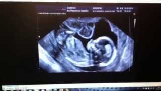 Amazing Ultrasound 15 weeks  Baby drinking fluid [upl. by Amluz]