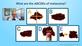 What are the signs and symptoms of melanoma [upl. by Novek]