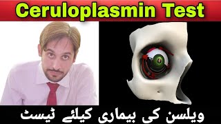 Ceruloplasmin Test  Ceruloplasmin Test in Hindi  Ceruloplasmin Biochemistry [upl. by Etram]