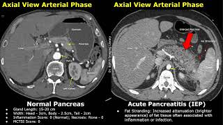 CT Normal Pancreas Vs Acute Pancreatitis  Balthazar Modified CT Severity Index MCTSI Scoring [upl. by Rosenfeld]