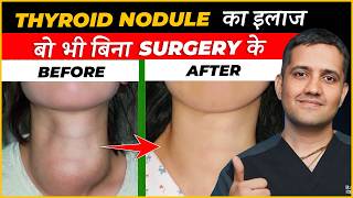 What is most modern non surgical treatment for thyroid nodule  Dr Gaurav Gangwani IR [upl. by Ullund673]