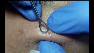 Big Blackheads on cheek removed Original ASMR pimple video [upl. by Harsho]