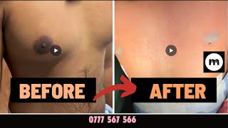 Do you want to see gynecomastia surgery results from 1 centre for gynecomastia treatments [upl. by Narmak]