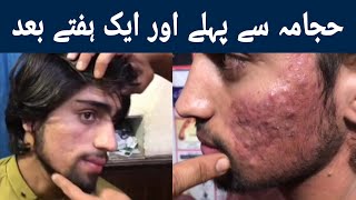 Hijama for Skin Care  Face Hijama  Face Acne Treatment  Wet Cupping [upl. by Sielen754]