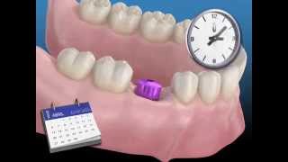 Todo sobre los implantes dentales [upl. by Lula664]