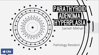 Parathyroid adenoma  Hyperplasia [upl. by Hardigg]