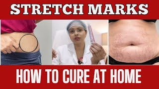 Stretch Marks Kaise Hatayen How to Remove Stretch Marks at Home  Honest Review [upl. by Gievlos]