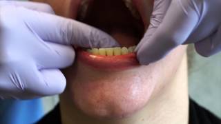 Flossing a Lower Fixed Retainer Lower Lingual Bar [upl. by Shamus]