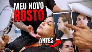 ME OLHEI NO ESPELHO E CHOREI Meu ROSTO após 7 DIAS da CIRURGIA DE FEMINIZAÇÃO 😱 [upl. by Towland]