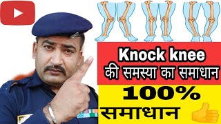 Solution Of Knock knee Problem  knock knee problem solve in 20 days knock knee की समस्या का समाधान [upl. by Vharat]