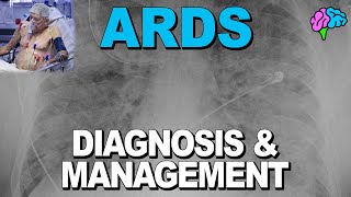 Diagnosis and Management of Acute Respiratory Distress Syndrome ARDS [upl. by Tnomel688]