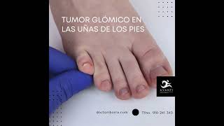 TUMOR GLÓMICO EN LAS UÑAS DE LOS PIES [upl. by Goodkin]